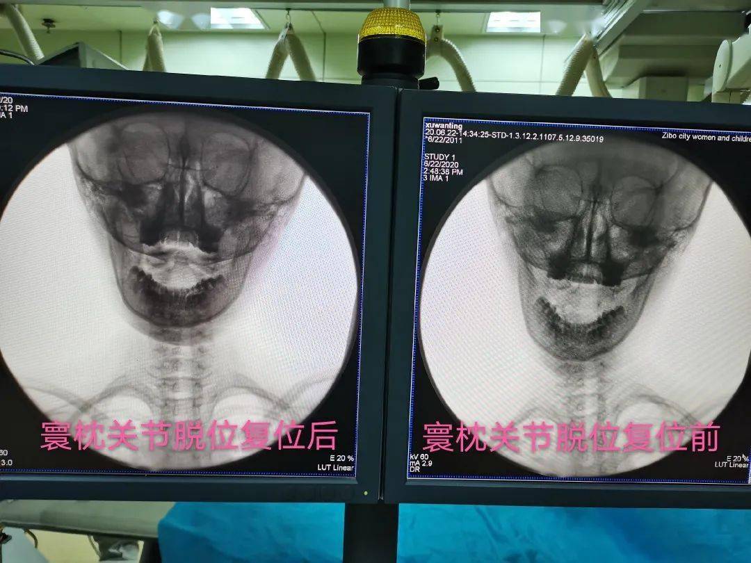 於是又複查了三維ct,最終診斷為