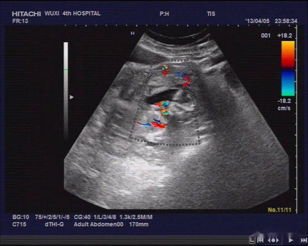超声典型病例 :阔韧带妊娠