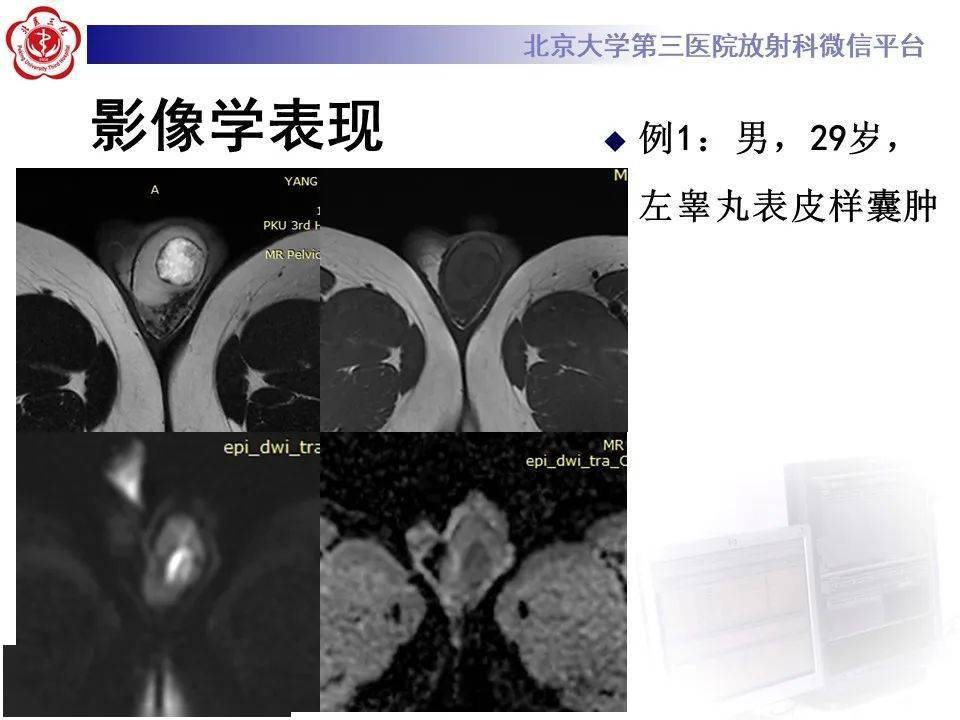 【每日一例1101】30岁男性,右侧睾丸有肿物,无明显疼痛