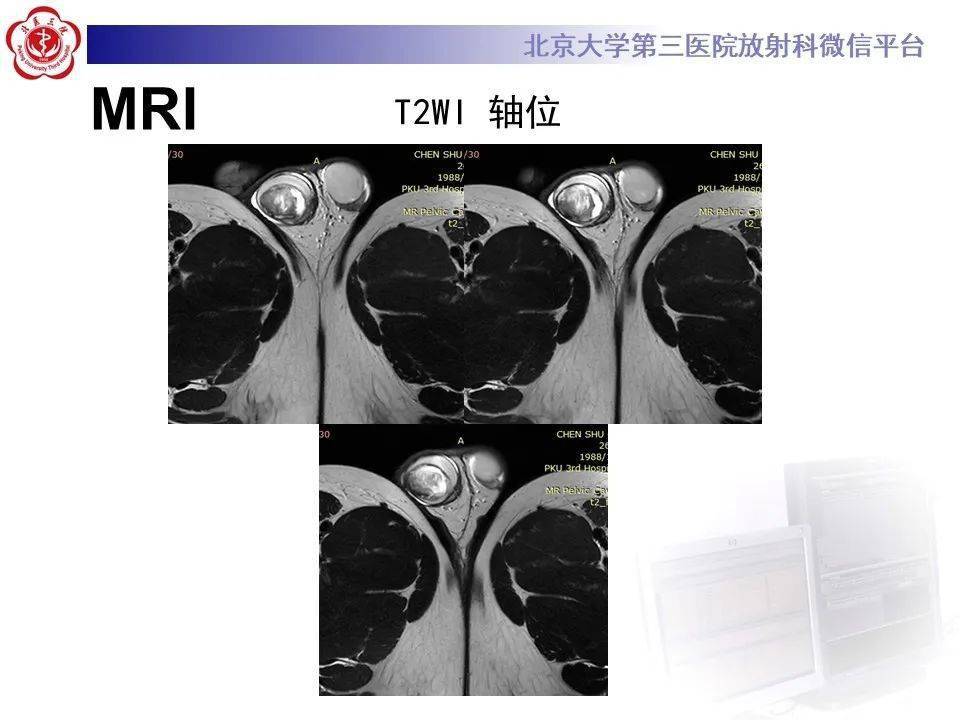 睾丸ct图片