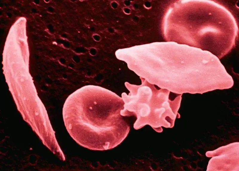 镰刀型细胞贫血症图片