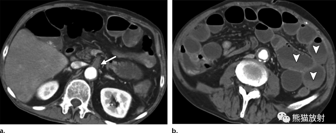 12种急性小肠疾病ct表现你知道多少