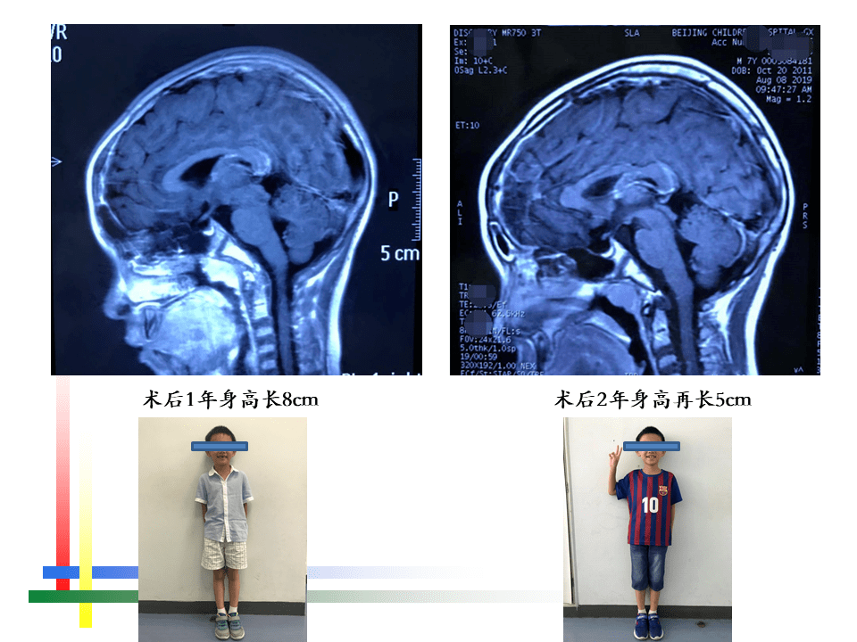 解剖课件 儿童鞍区肿瘤常见手术入路 北京儿童医院葛明