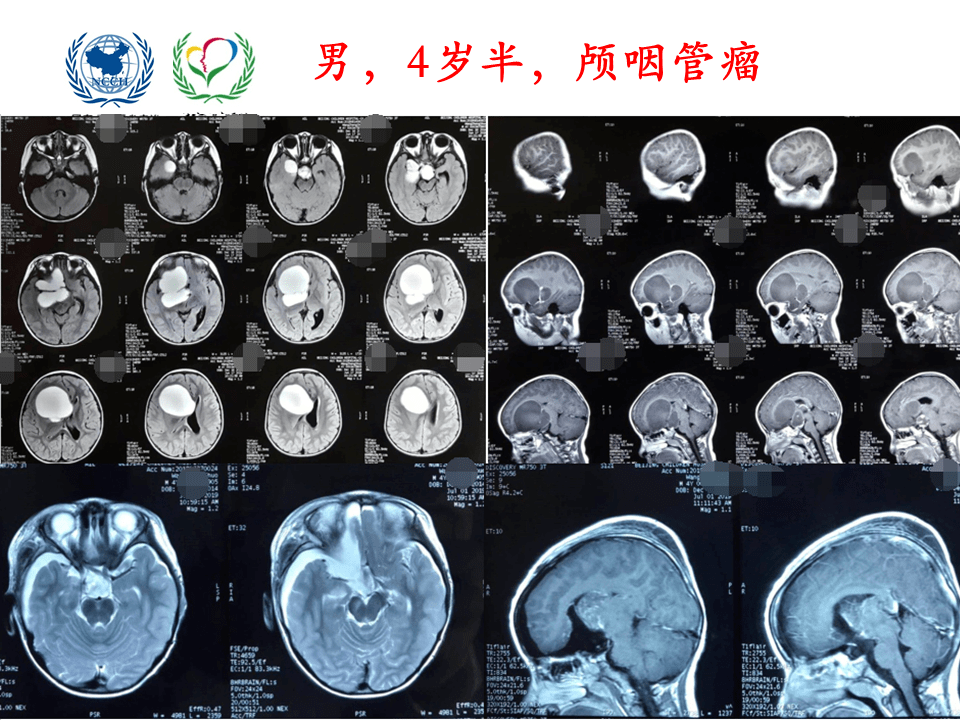 解剖课件 儿童鞍区肿瘤常见手术入路 北京儿童医院葛明