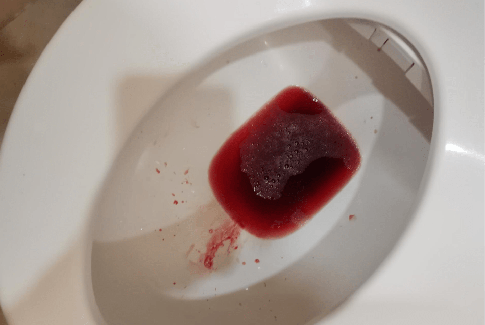 尿液偏红图片