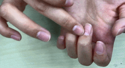 灰指甲为何难治愈这些治疗误区现在知道还不晚