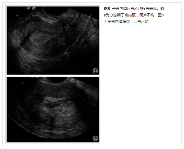 超声女孩三线征图片图片