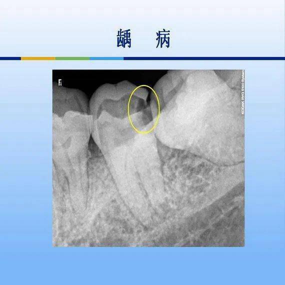 牙体牙周正常解剖及常见病x线表现