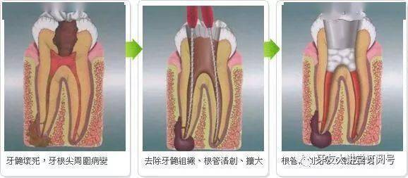 根管治療斷針原因及解決辦法