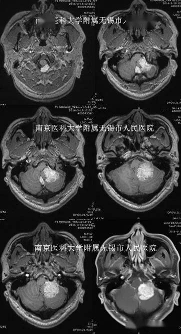 桥小脑角区肿瘤图片
