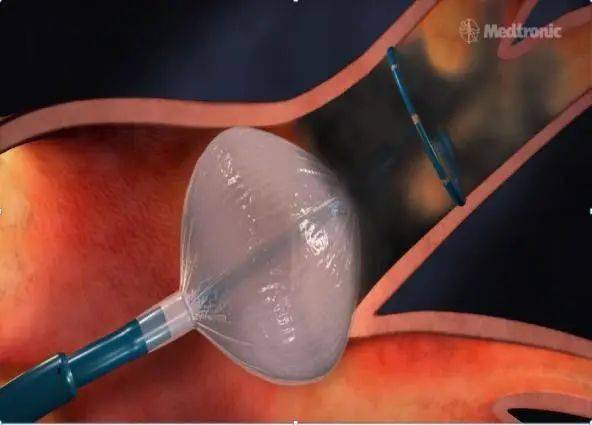 新闻|嘉兴一院心血管内科开展市首例冷冻球囊消融术