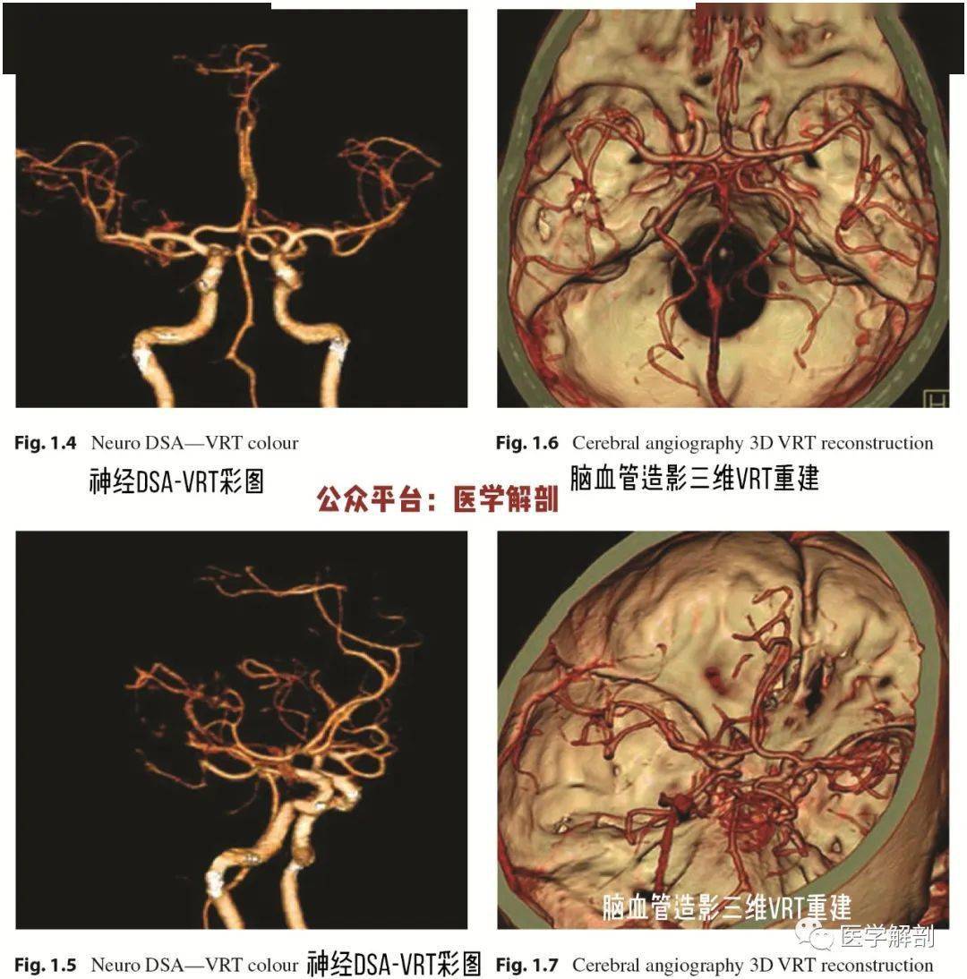 脑cta图谱正常大脑动脉造影