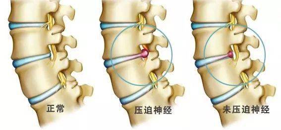 腰椎养护丨关于腰椎间盘突出的九大误区_症状