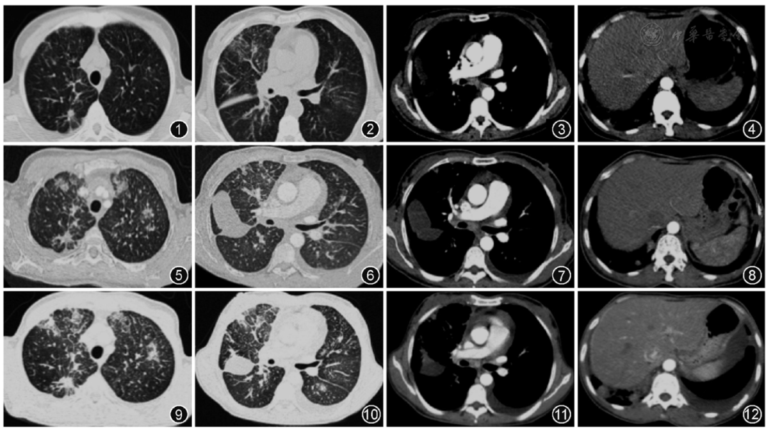 临床病例理讨论以肺栓塞起病的双肺多发病变