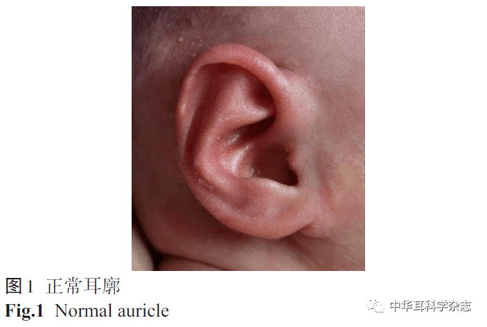 正常耳廓:如图1所示:耳轮弧度自然丰满,对耳轮上,下脚及舟状窝清晰,颅