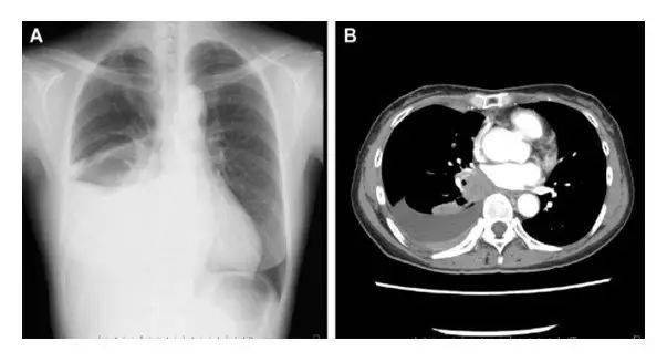 中央型肺癌图片