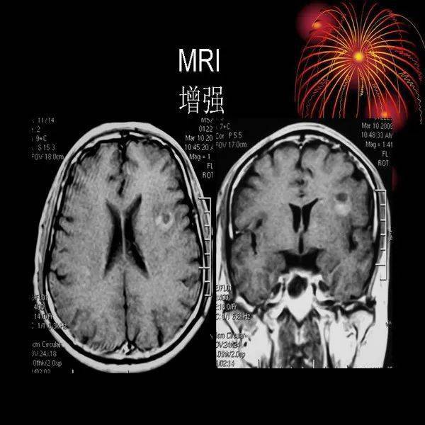 腫瘤樣脫髓鞘病變影像特徵以及鑑別診斷