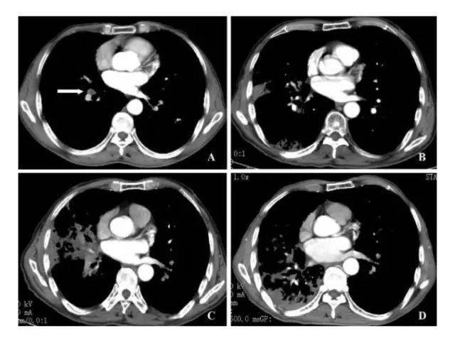 肺癌核磁共振图片图片