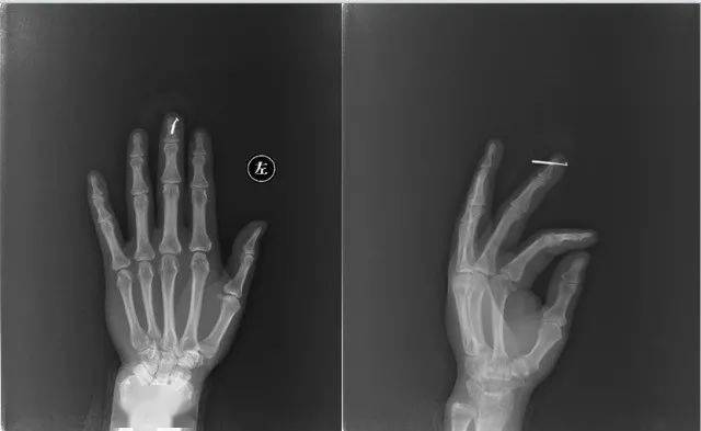 110张经典x线片影像诊断,夜班医生必备纯干货!