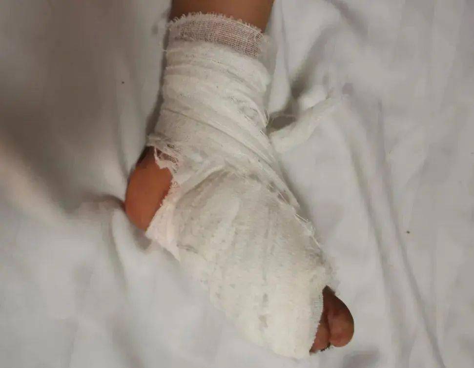 贵州丨心疼2岁小女孩双脚被烫伤因没钱治疗落下残疾