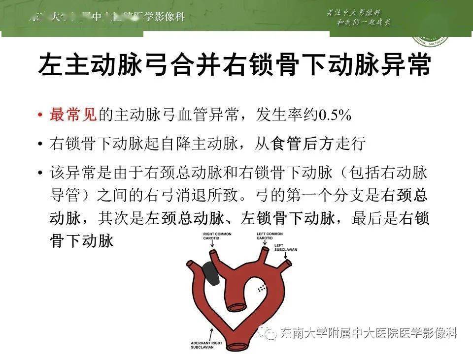 07.14 循环系统疾病——右迷走锁骨下动脉