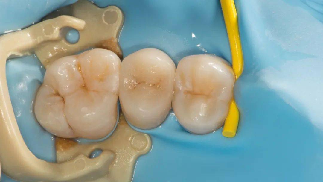 松风病例秀刘勇流体树脂新应用f00粘接嵌体