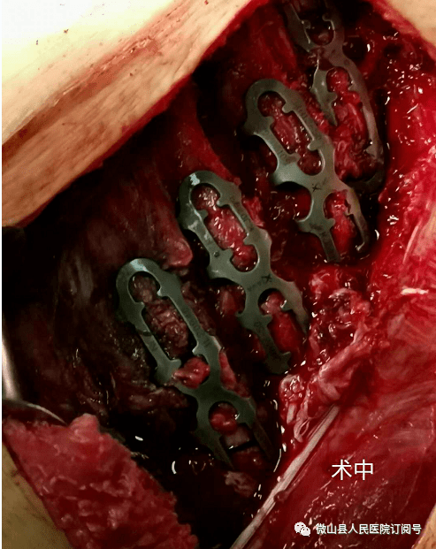 微山县人民医院成功完成一例高难度胸部外伤手术