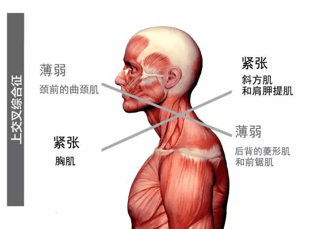 圆背,经常肩背痛,需警惕上交叉综合征