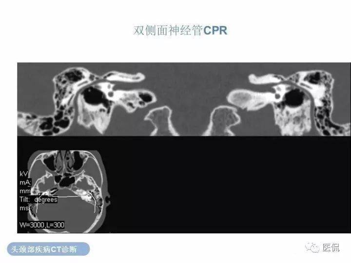 經典收藏最全顳骨詳細ct解剖