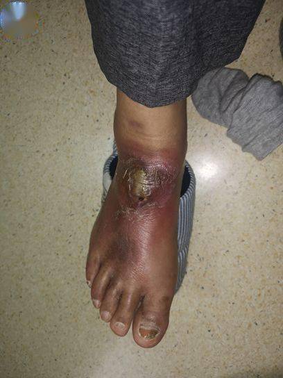 糖尿病足伤口标本采集