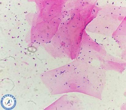 糖尿病足伤口标本采集