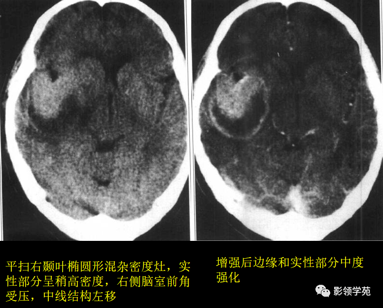 胶质母细胞瘤的ct表现与单发巨大的转移瘤表现相似,二者在ct影像上不