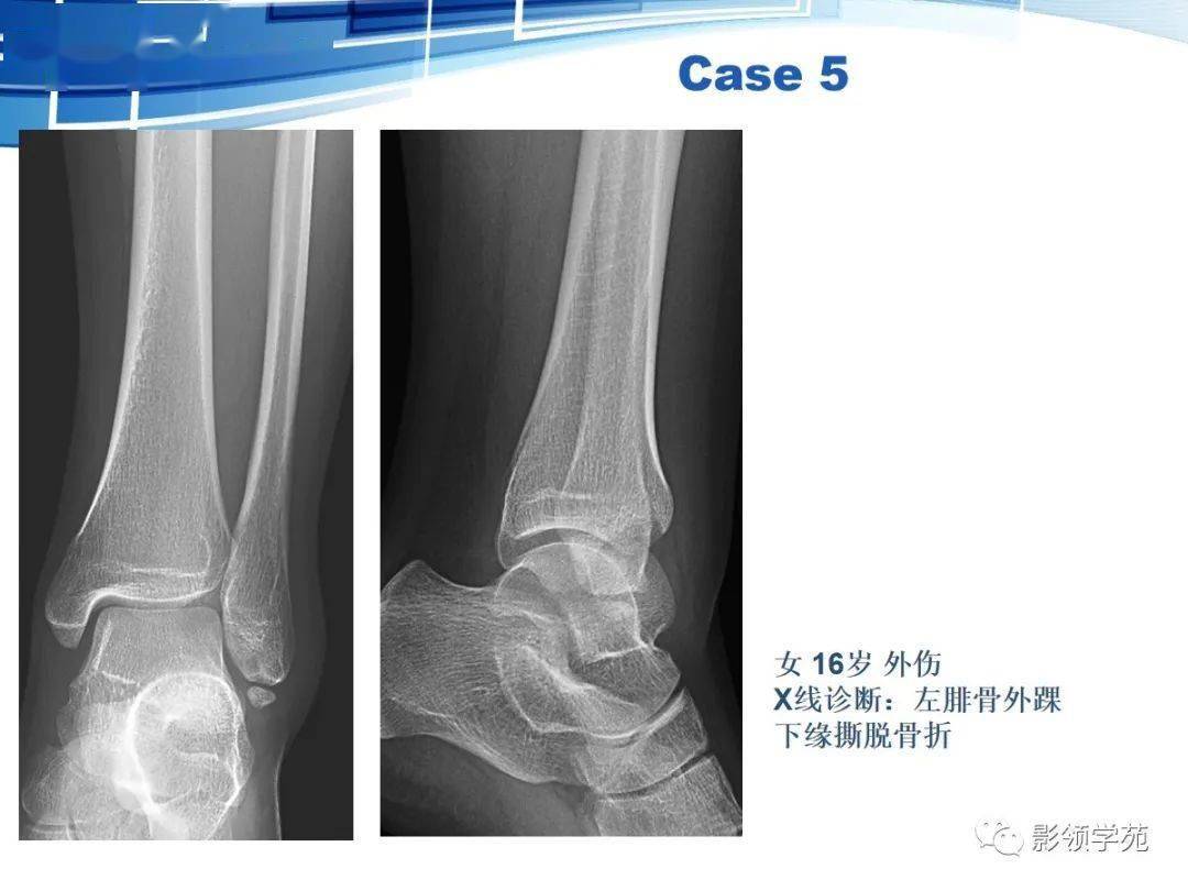 骨常见变异与撕脱骨折鉴别诊断