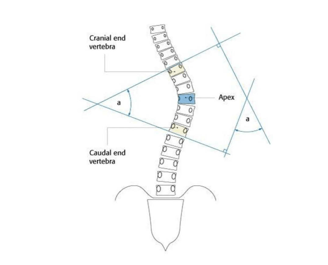 然後由專業醫生測量cobb角度,cobb角10°以上者為脊柱側彎畸形