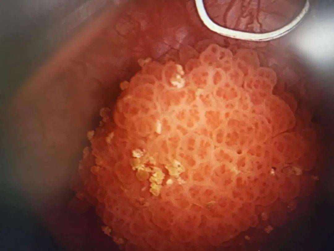 58岁退休老司机患上膀胱癌,他同时有这两个坏习惯