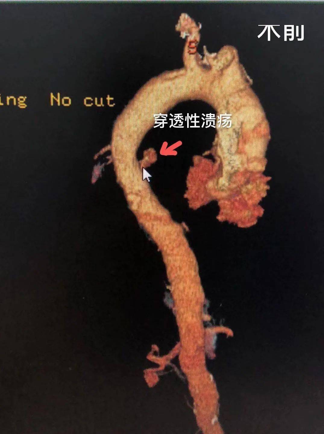 术前检查▲术后造影手术一个小时,成功为患者行局麻下胸主动脉腔内