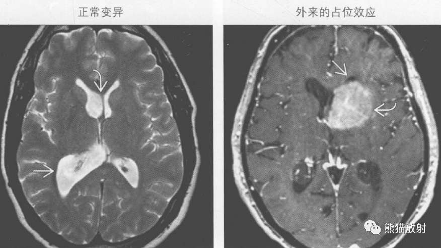 佔位可以導致腦室變形,大腦鐮下疝病因包括佔位,出血,梗死,感染外來的