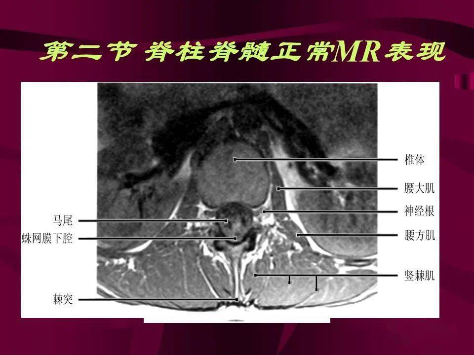 脊柱和脊髓病变mri诊断