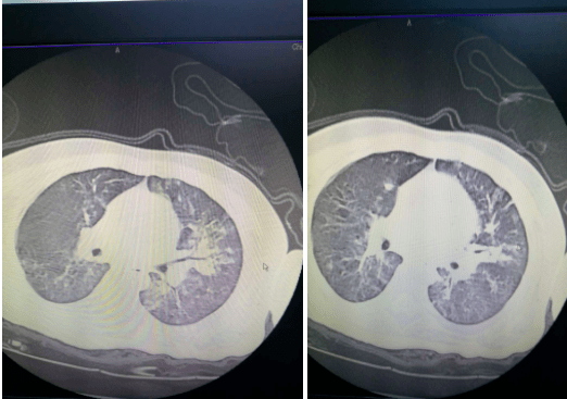 ct:肺紋理增粗,兩肺沿支氣管分佈可見斑片狀,片狀密度影.