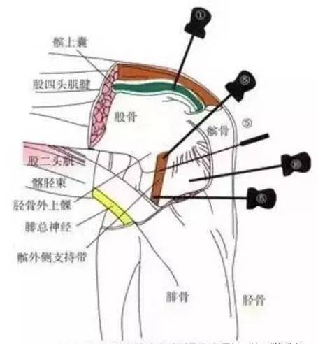 ④髌骨下极点刀口线与肢体纵轴平行,刀体与皮面垂直,快速刺人皮肤