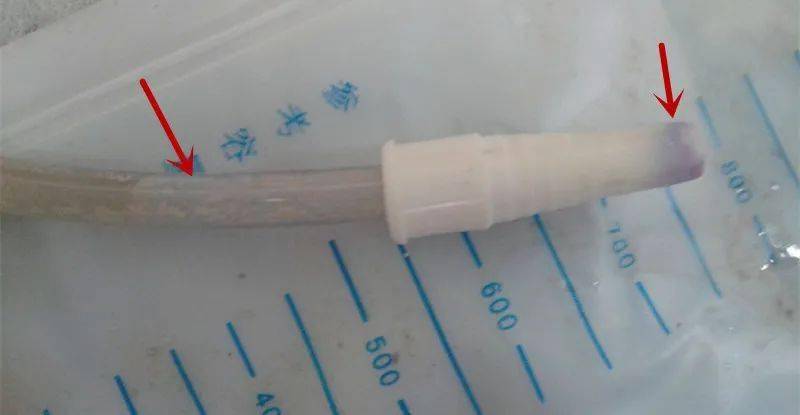 原來這就是紫色尿袋綜合徵,是指長期留置尿管後尿管,尿袋出現色素沉澱