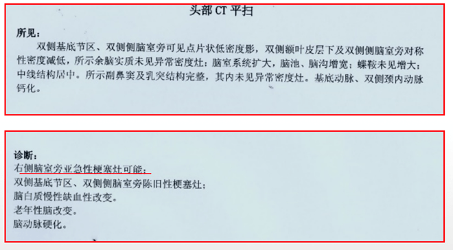 13 同时,患者进行了头颅ct检查,提示右侧脑室旁亚急性梗塞灶可能