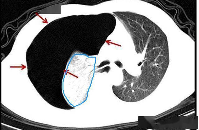 肺大泡ct图片解读图片