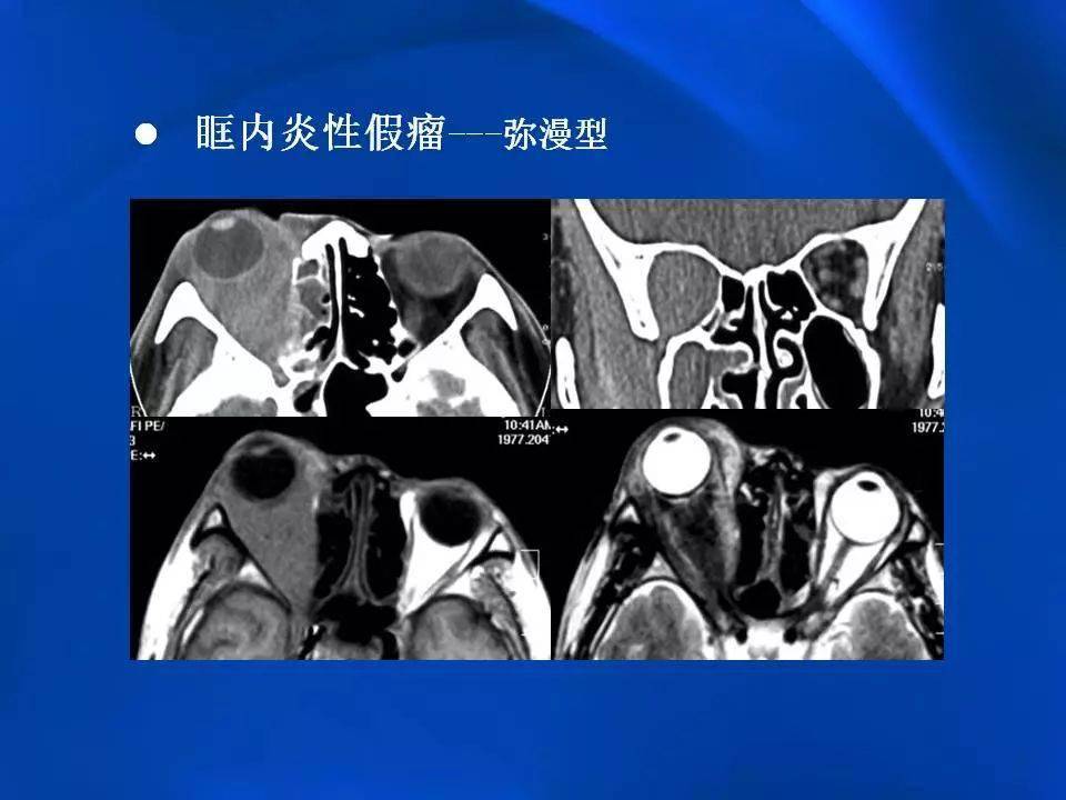 眶内炎性假瘤影像学表现