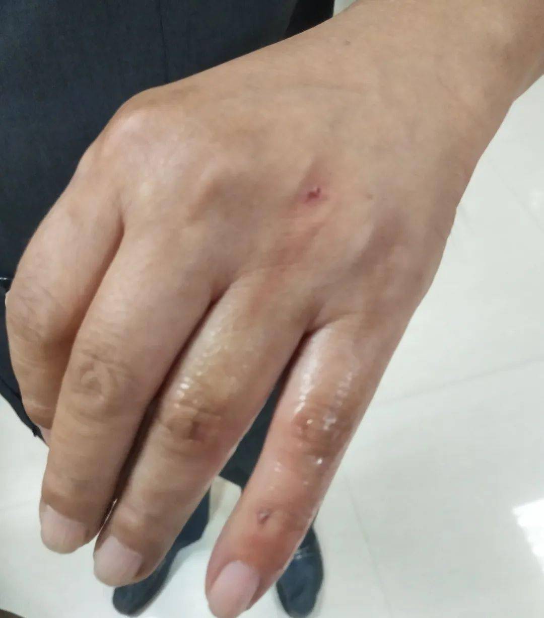 南部一被执行人咬伤执行法官