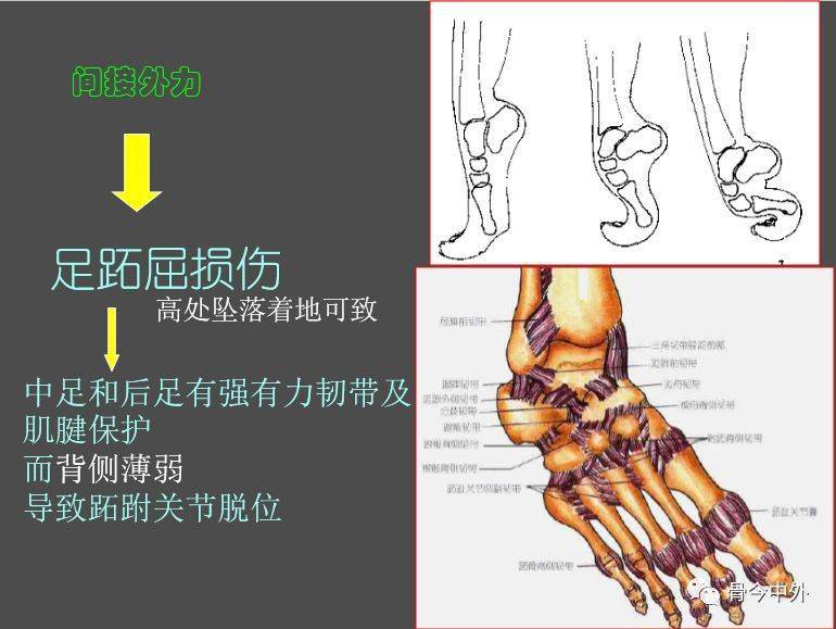 解读关于lisfranc损伤的4个知识点