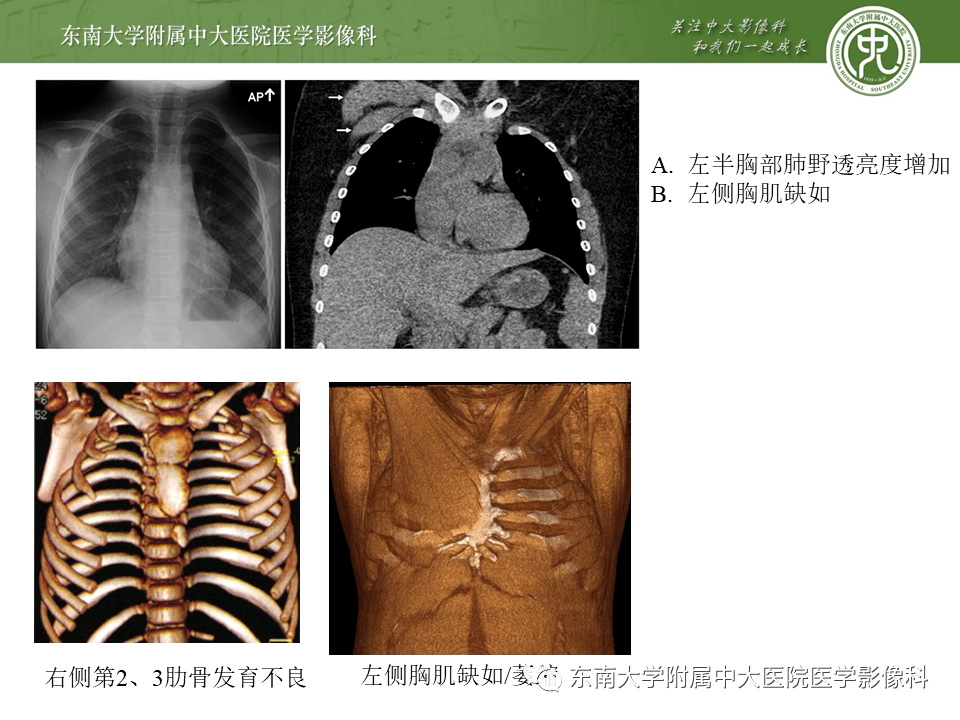 肌骨系統疾病poland綜合徵