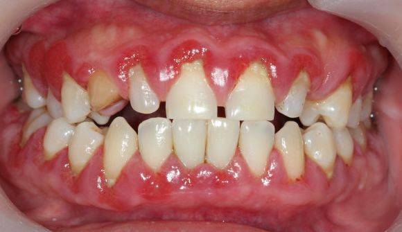 肾病患者为何会出现牙龈病变