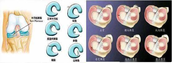 半月板損傷機理分型診療及康復