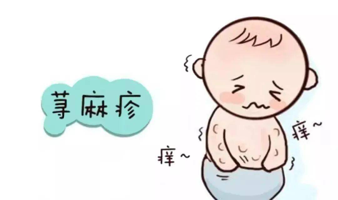 【医文医话】罗小军:不可小觑的荨麻疹(一)_症状